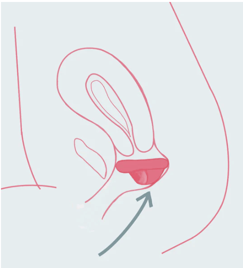 Menstruationsscheibe Rosé mit Eingriff - La Blutique rayne careMenstruationsscheibe Berlin